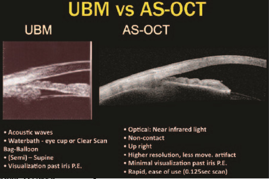 Ultrazvukovaya-Biomkiroskopiya-i-lechenie-glaukomy.jpg
